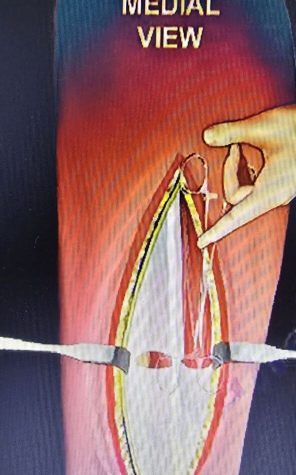 Балаковские медики отмечают рост числа "лыжных" травм