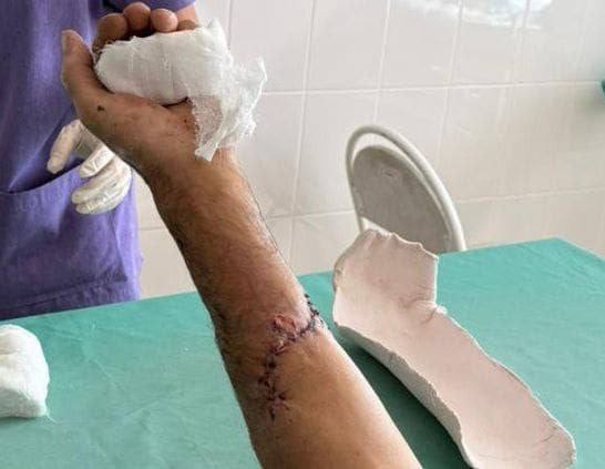 Саратовские врачи спасли отрезанную бензопилой руку пациента