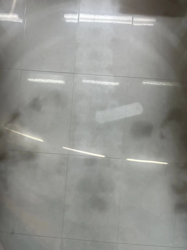 Балаковские врачи спасли двух проглотивших батарейки детей