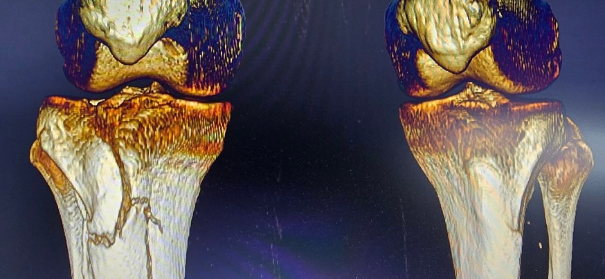 Балаковские медики отмечают рост числа "лыжных" травм