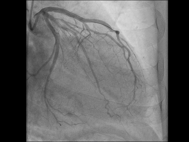 В Балакове медики спасли мужчину, перенесшего инфаркт во время уборки снега