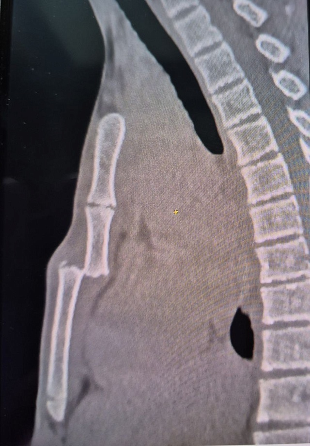 В Балакове 16-летний подросток получил перелом грудины, занимаясь на турнике