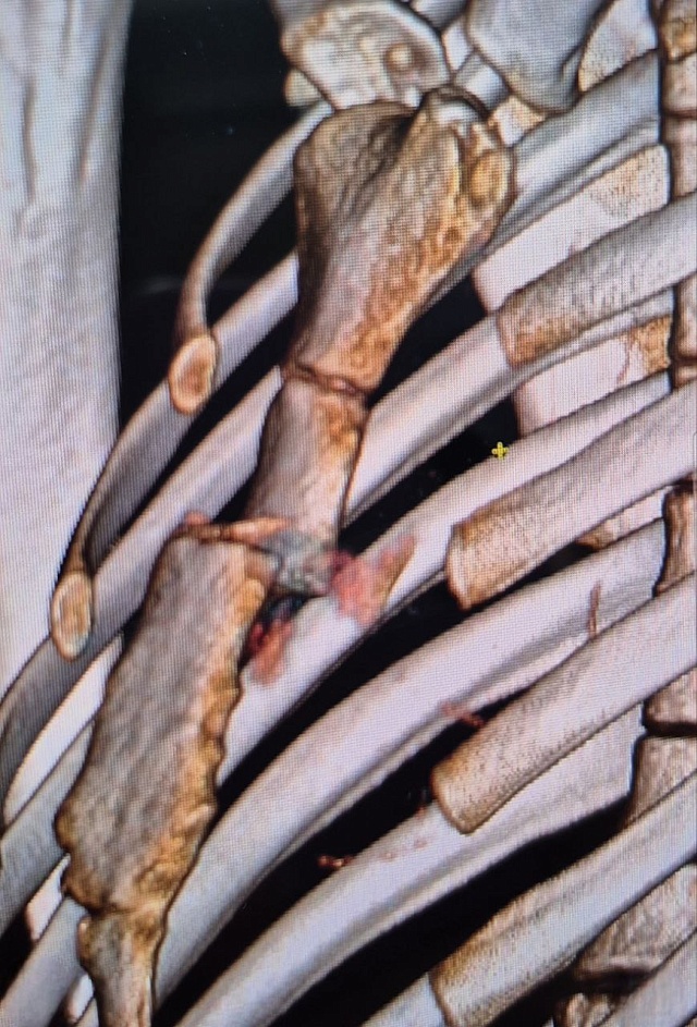 В Балакове 16-летний подросток получил перелом грудины, занимаясь на турнике