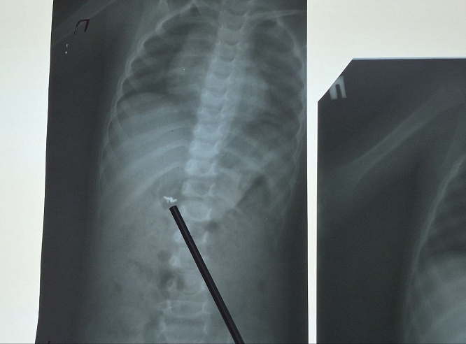 В Саратовской области один ребенок проглотил застежку от цепочки, другой - монету