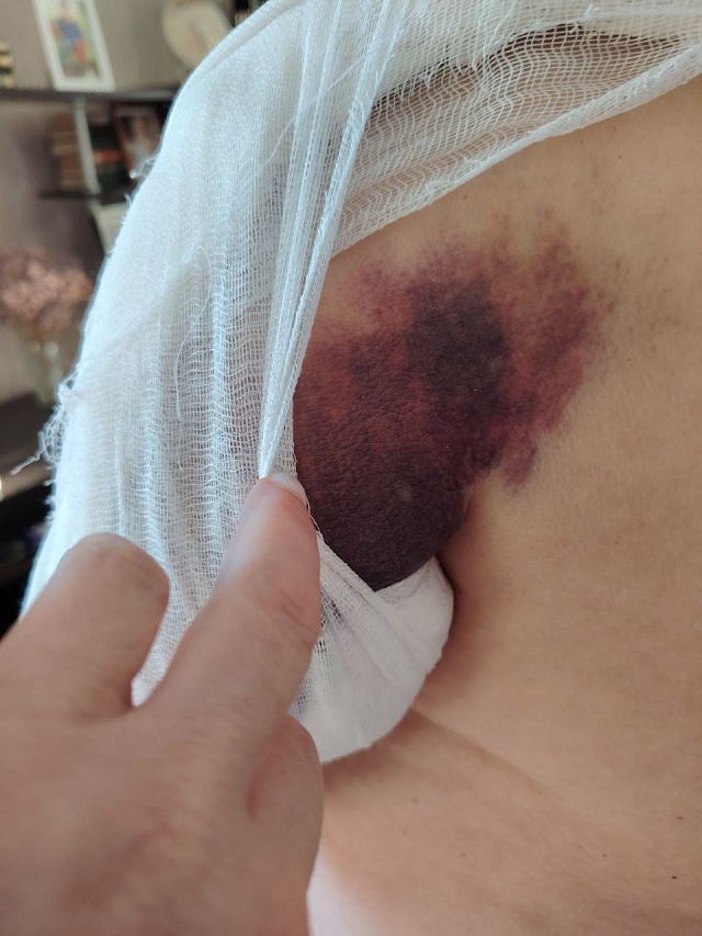 В Саратове пенсионерка сломала плечо из-за падения в автобусе