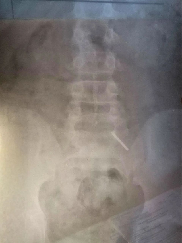 В Балакове 11-летний школьник проглотил часть циркуля