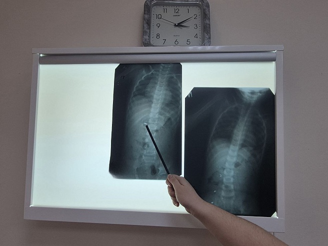 В Саратовской области один ребенок проглотил застежку от цепочки, другой - монету