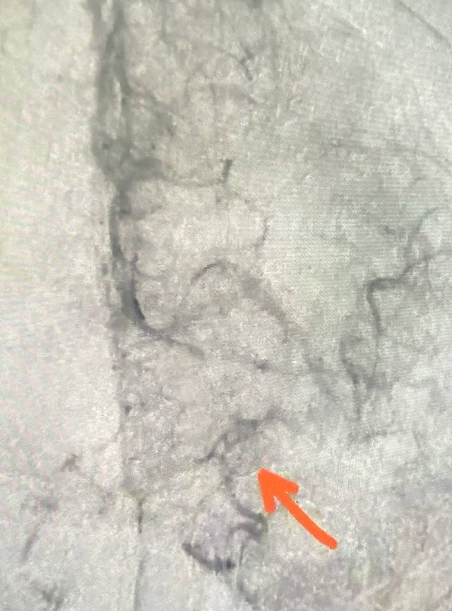 Саратовские врачи спасли 20-летнюю пациентку с инсультом