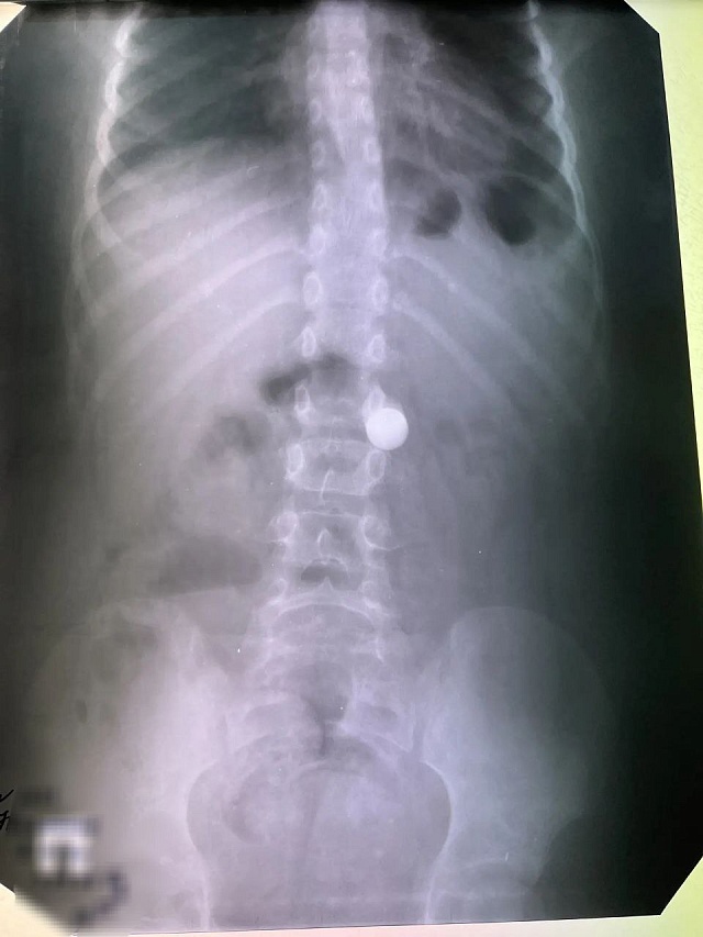 В новогодние праздники балаковские врачи достали из восьмилетнего мальчика металлический шарик