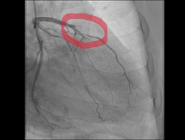 В Балакове медики спасли мужчину, перенесшего инфаркт во время уборки снега