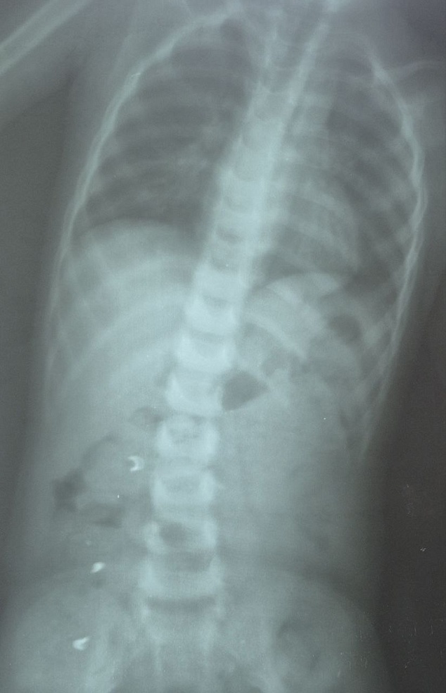 В Саратовской области один ребенок проглотил застежку от цепочки, другой - монету