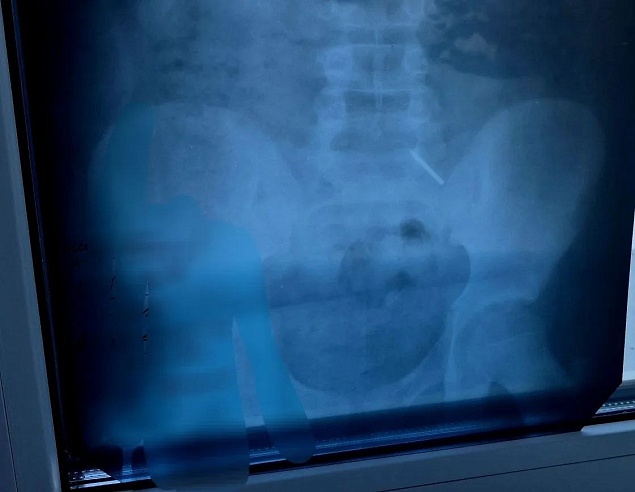 В Балакове 11-летний школьник проглотил часть циркуля